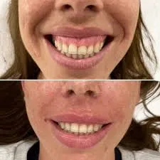 Tratamientos faciales y corrección de sonrisa gingival